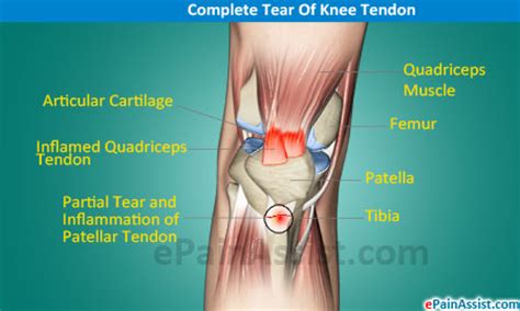 Knee issues come in three general categories: Knee Joint Tendonitis|Types|Symptoms|Treatment ...