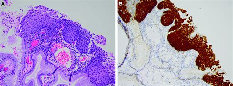 Potential Influence Of P16 Immunohistochemical Staining On The