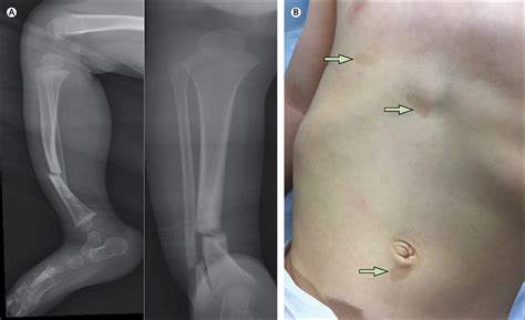Pathological Tibia Fracture In An 18 Month Old Child The Lancet Child