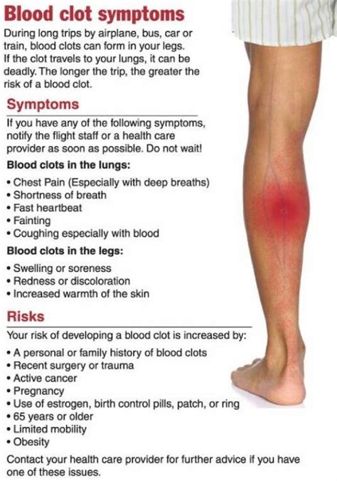 Blood Clot Symptoms Hand These Are The Symptoms And Signs You May