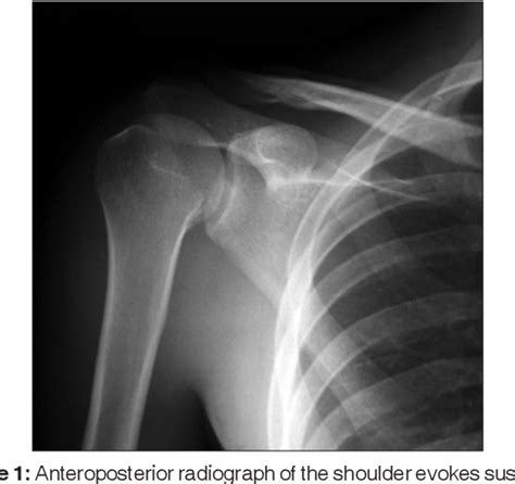 Figure From Isolated Avulsion Fracture Of Lesser Tuberosity Of The
