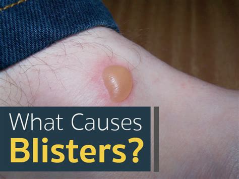 Blisters Causes Symptoms Treatment And Prevention Safe Home Diy