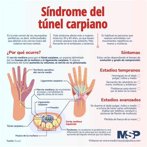 Síndrome Del Tunel Carpiano Infografía