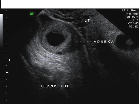 Ultrasound Image Gallery Ultrasound Ovaries Corpus Luteum
