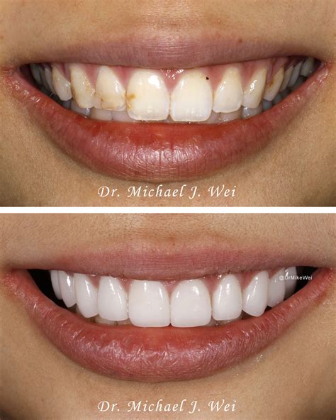 how much do porcelain veneers cost in manhattan price and payment options in nyc