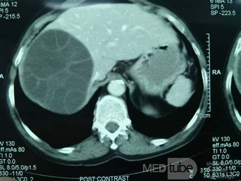 Liver Hydatid Cyst • Picture •