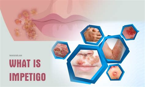 What Is Impetigo Causes Symptoms Treatment And Prevention