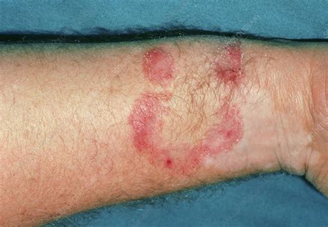 The Wrist Of A Patient Affected By Ringworm Stock Image M2700090
