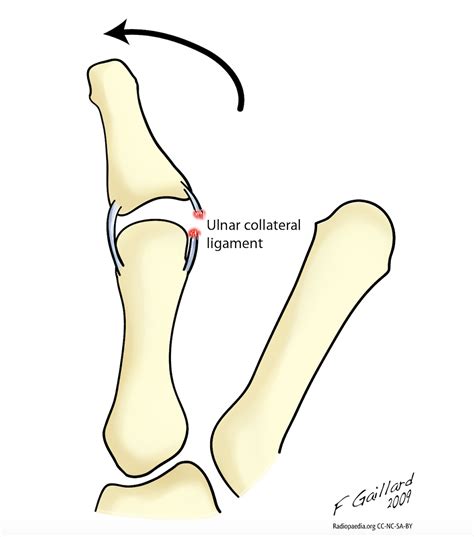 Ulnar Collateral Ligament Ucl Injury Of Thumb The Lothian Hand Unit