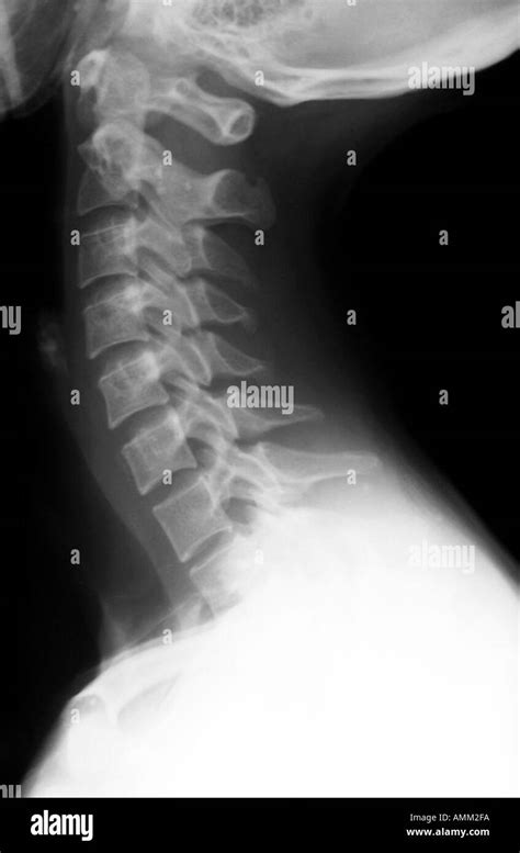 X Ray Normal Cervical Spine Stock Photo Alamy