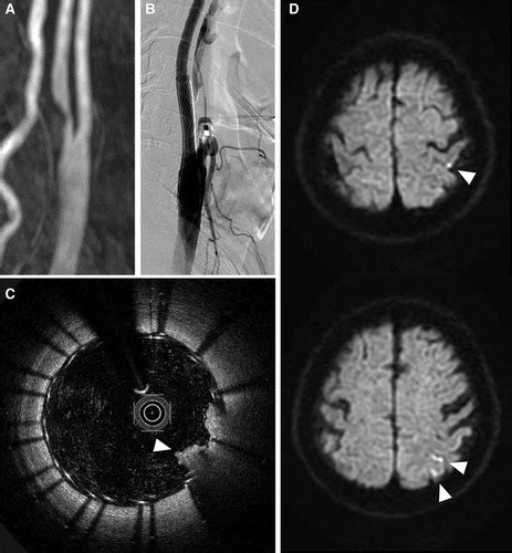 Ischemic Brain Lesions After Carotid Artery Stenting Increase Future