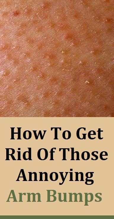 How To Get Rid Of Those Annoying Arm Bumps Keratosis Pilaris In 2020