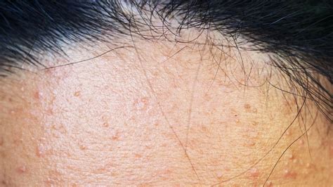 Keratosis Pilaris On The Face Symptoms Treatments And More