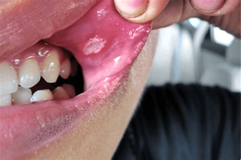Ulcers On Tongue Gums And Lips