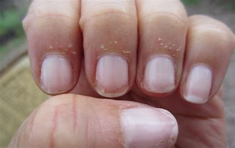 Nails Peeling After Gel 19 Discover Beautiful Designs And Decorating