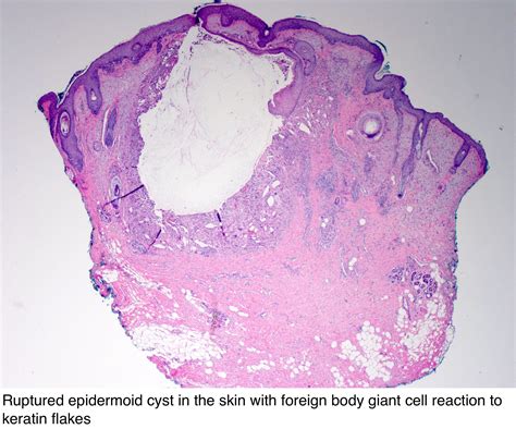 Pathology Outlines Epidermal Epidermoid Type