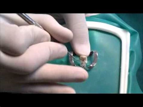 Incisivo Central Superior Endodoncia - YouTube