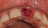 Treatment For Dry Socket After Tooth Removal