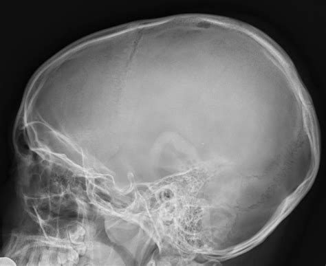 Eosinophilic Granuloma Radiology Case
