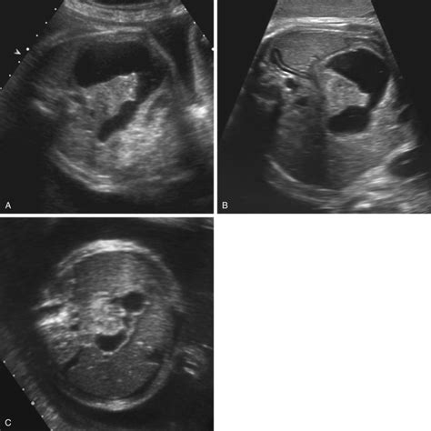 Ultrasound Evaluation Of The Fetal Gastrointestinal Tract And Abdominal