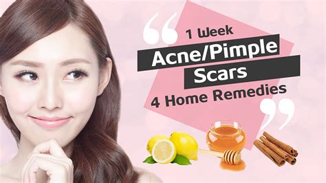 Also, you can apply a moisturiser after direct application. HOW TO REMOVE ACNE SCARS/PIMPLE MARKS AT HOME. [ACNE SCARS ...