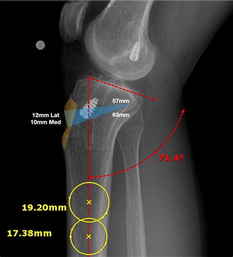 Posterior Tibial Slope Is Measured By Calculating The Angle Between The
