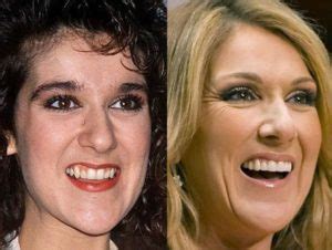 Celine Dion Before And After Plastic Surgery Face Nose Teeth