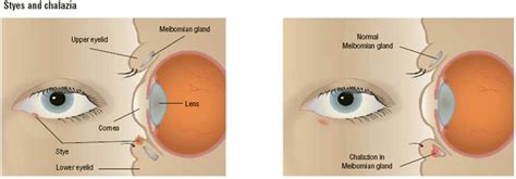 Eyelid Disorders Overview What Are Eyelid Disorders How Common Are