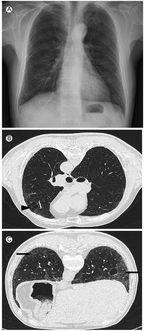 A The Posteroanterior Pa Chest X Ray Showed Diffuse Reticulation In