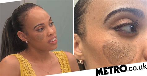 Botched Guest Has Pubic Hair Growing From Face After Skin Graft Metro News