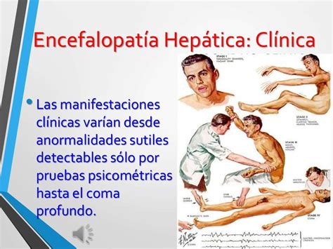 Sintomas De Encefalopatia Hepática