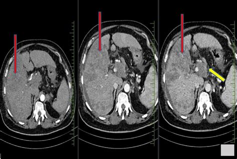 Triple Phase Liver Imaging Axial Ct Shows Ill Defined Heterogeneously