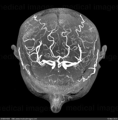 Stock Image Visualization Of The Normal Circle Of Willis And Normal
