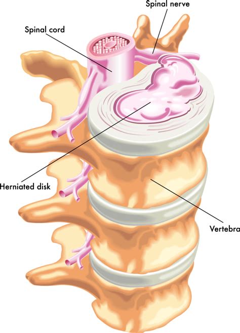 I'm not a doctor but i wouldnt think a muscle strain would come back over 6 months from an injury unless you do have some sort of disc issue causing your muscles to tighten up. Back Pain | Herniated Discs vs. Bulging Discs | The Center