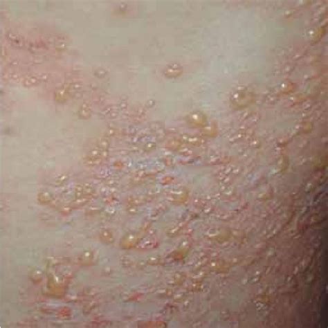 Pdf Bullous Skin Disease In Systemic Lupus Erythematosus