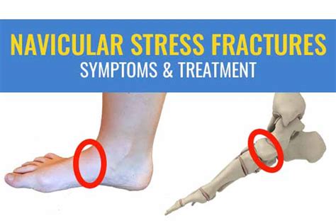 Navicular Stress Fractures Symptoms And Treatment