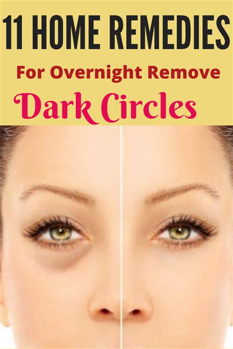 How To Remove Dark Circles Under Eyes At Home Permanently Howtoremvo
