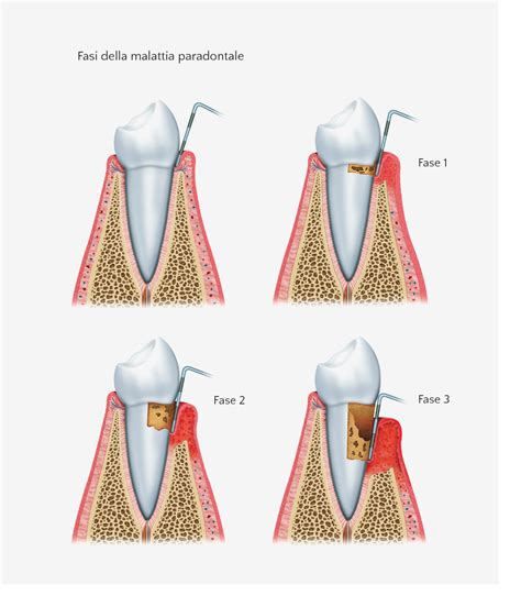 Parodontologia Studio Dentistico Dr Pavanetto A E Dr Del Giudice A