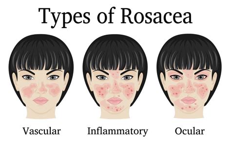 Rosacea Symptoms Causes Treatment And Photos