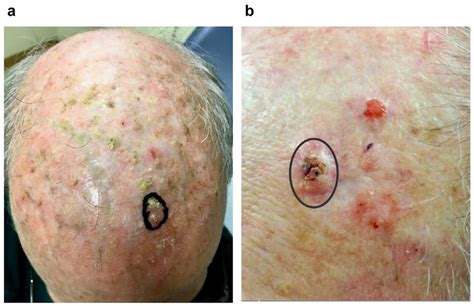 Types Of Skin Cancer Squamous Cell Carcinoma