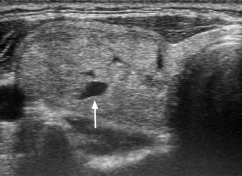 An Isoechoic Nodule With Minimal Cystic Changes In A 47 Year Old Woman
