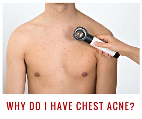 How To Treat Chest Acne Pimples Scars And Bumps