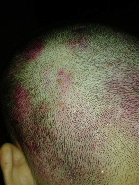 Scalp eczema hair loss healthy hair begins with a healthy scalp. Eczema Scalp Pictures - 10 Photos & Images / illnessee.com