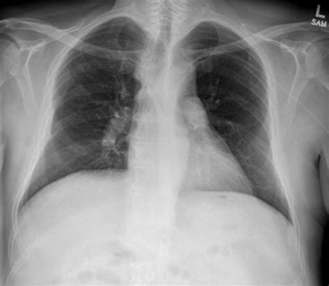 Chest X Ray Pulmonary Embolism