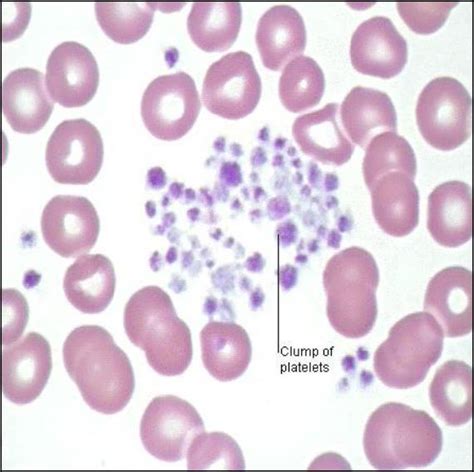 Platelet Clumping Or Aggregation Medical Laboratories
