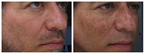 Ipl Boca Ratons Hottest New Skin Treatment