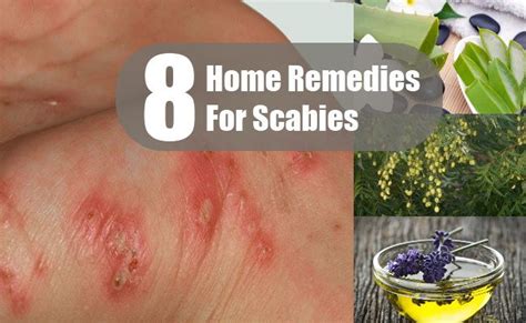 Home Remedies For Scabies Home Remedies Scabies