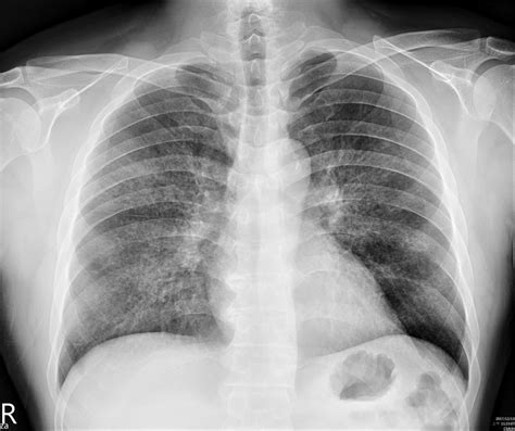 Chest X Ray Revealed Non Specific Interstitial Infiltration Over