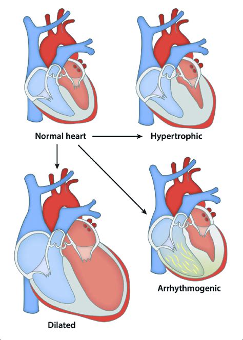 Hypertrophic Cardiomyopathy Types