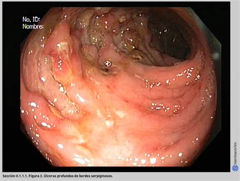 Without treatment, symptoms of crohn's disease can be constant or may come and go every few weeks or months. Endoscopia en la enfermedad de Crohn
